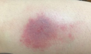 蚊子咬了红肿怎么止痒（让蚊子咬了痒怎么止痒消肿）