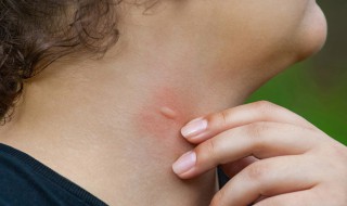 被蚊子咬后第二天起包吗（被蚊子咬后第二天起包吗会痒吗）