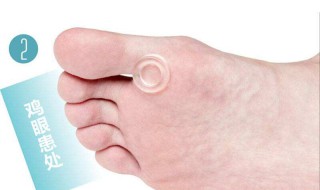 什么是鸡眼 什么是鸡眼及治疗方法