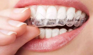 牙套适合年龄（牙套 适合年龄）