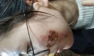 水痘坑的修复方法 水痘坑的修复方法视频