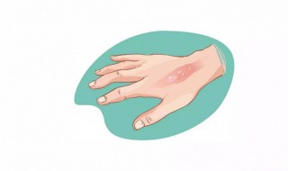 手被油烫伤起泡怎么处理 手被油烫伤起水泡怎么办