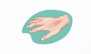 烟头烫伤后怎么处理（烟头烫伤后怎么办）