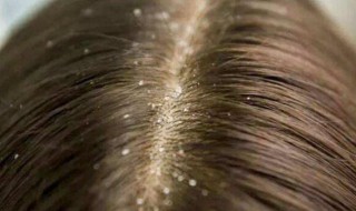 头皮里抠出的东西是什么 头皮里抠出的东西是什么成分