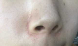 脸上有黑头怎么办（脸上有黑头是什么原因）