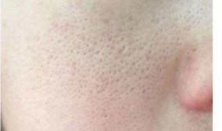 怎样收缩毛孔最有效又简单 一周内缩小毛孔最有效的方法