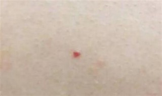 红痣代表什么 红痣代表什么命运