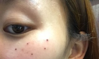 脸上的痣哪些不能点掉（男孩脸上的痣哪些不能点掉）