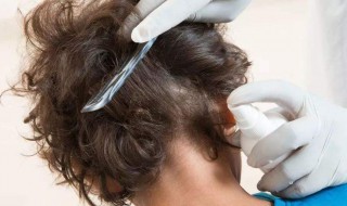 头上长虱子怎么办怎样消除（女生头上长虱子怎么办怎样消除）