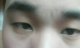 5分钟去黑眼圈小方法 眼袋是割掉好些还是微创手术好些