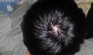 脱发了如何能让头发再生 脱发了如何能让头发再生起来