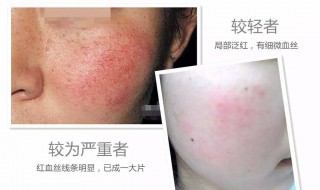 红血丝怎样去除 大腿上的红血丝怎样去除