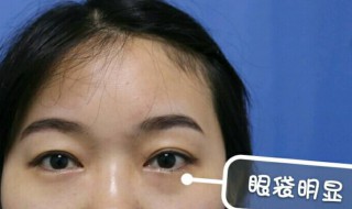 有什么祛眼袋的好方法（祛眼袋的小绝招）